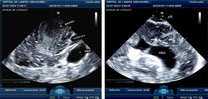 左圖顯示術(shù)中超聲見囊實性病變，大小約為4x4x3cm，病灶周圍腦組織水腫明顯；右圖為病灶切除后，術(shù)中超聲示術(shù)腔無病變殘留