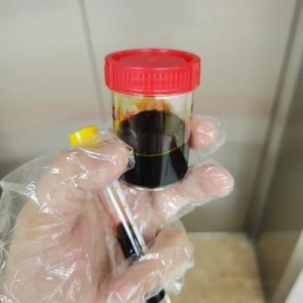 急性肝衰竭！兩兄弟誤吃這種菌 專家提醒