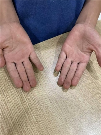 9歲小學(xué)生長期拍煙卡，手部粗糙長繭。受訪者供圖