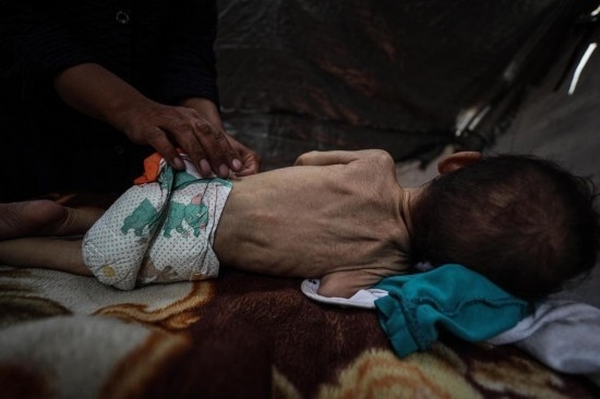 這是5月28日在加沙城西部一處臨時安置點拍攝的一名營養(yǎng)不良的嬰兒。新華社發(fā)（馬哈茂德·扎基攝）